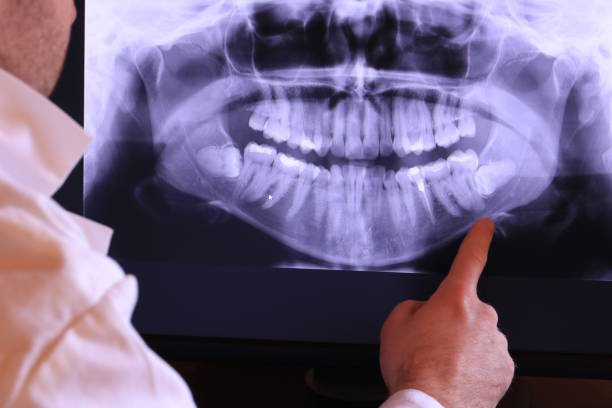 Best Knocked-Out Tooth (Avulsed Tooth) Treatment in Buckhannon, WV